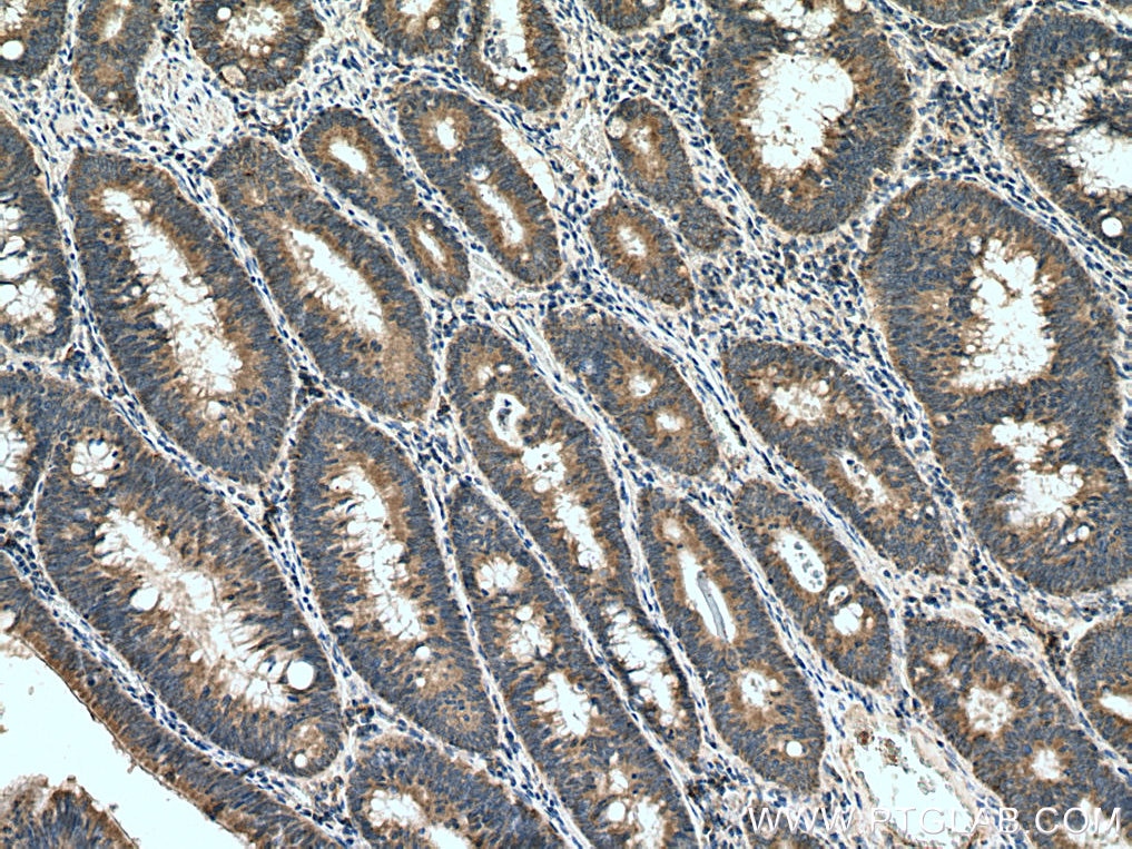 Immunohistochemistry (IHC) staining of human colon cancer tissue using CARD11 Polyclonal antibody (28483-1-AP)
