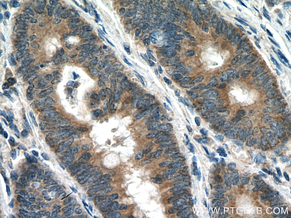 Immunohistochemistry (IHC) staining of human colon cancer tissue using CARD11 Polyclonal antibody (28483-1-AP)