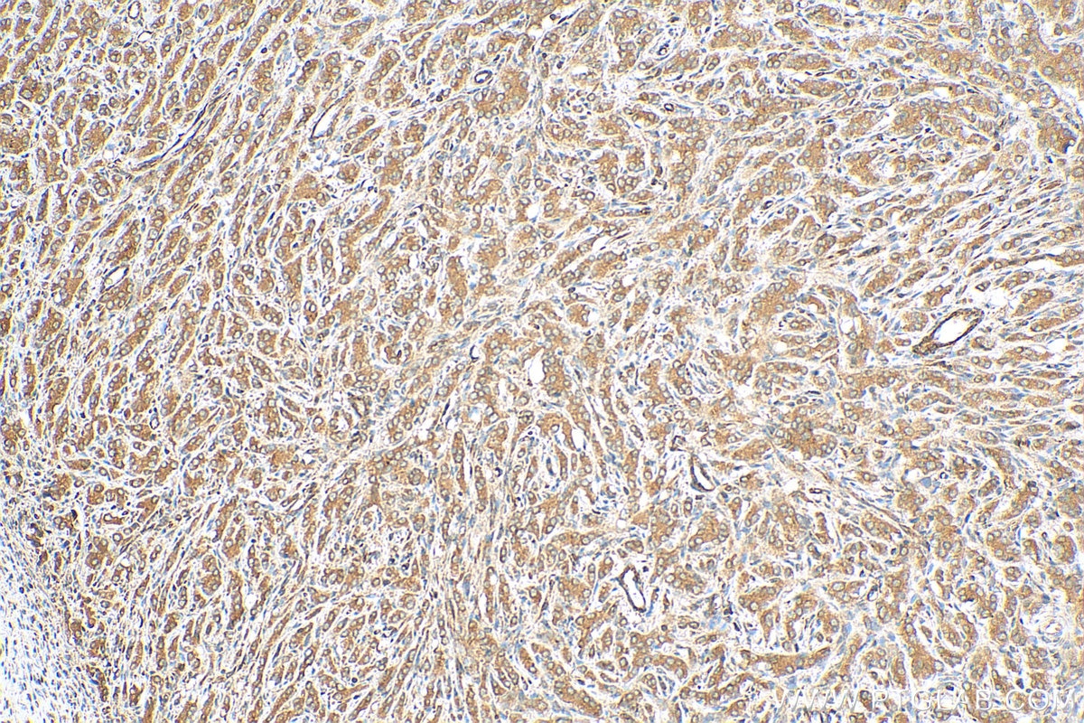 Immunohistochemistry (IHC) staining of human prostate cancer tissue using CARD8 Polyclonal antibody (14516-1-AP)
