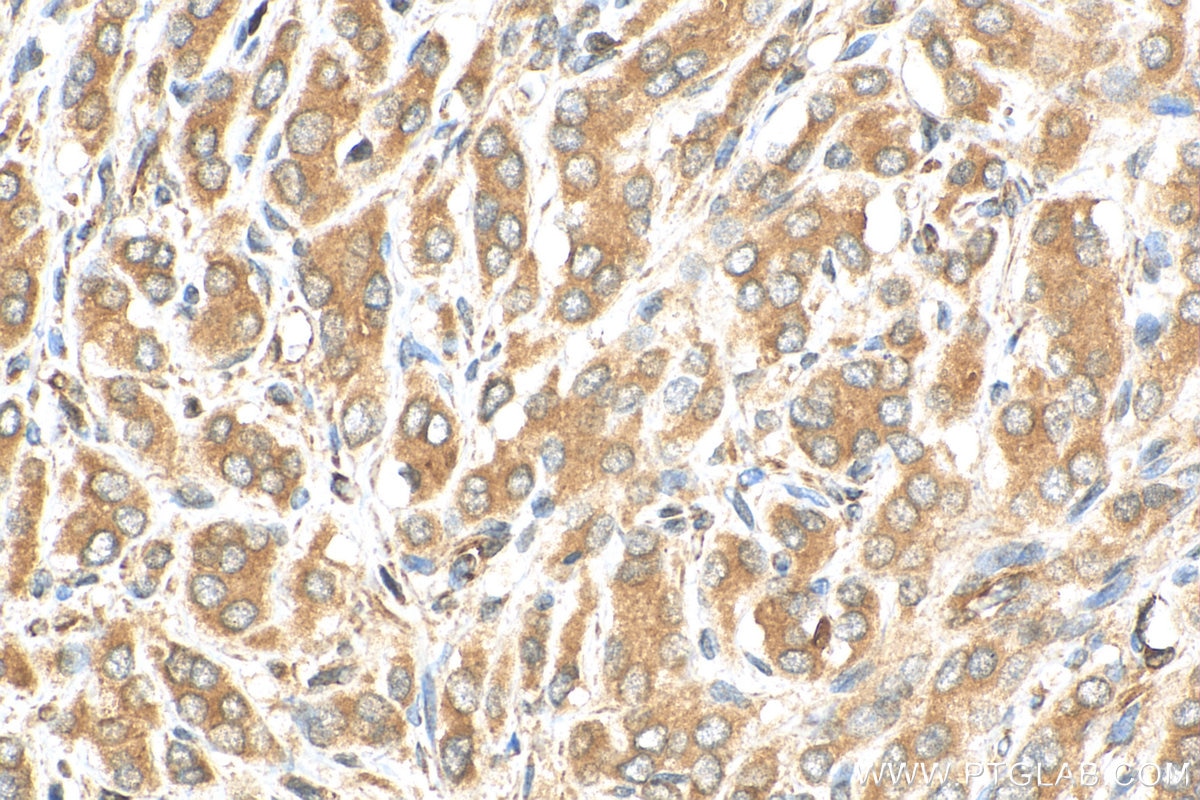 Immunohistochemistry (IHC) staining of human prostate cancer tissue using CARD8 Polyclonal antibody (14516-1-AP)