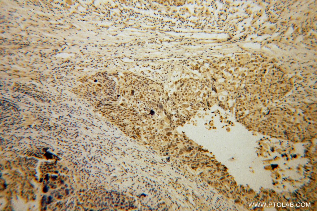 Immunohistochemistry (IHC) staining of human ovary tumor tissue using CARD8 Polyclonal antibody (14516-1-AP)