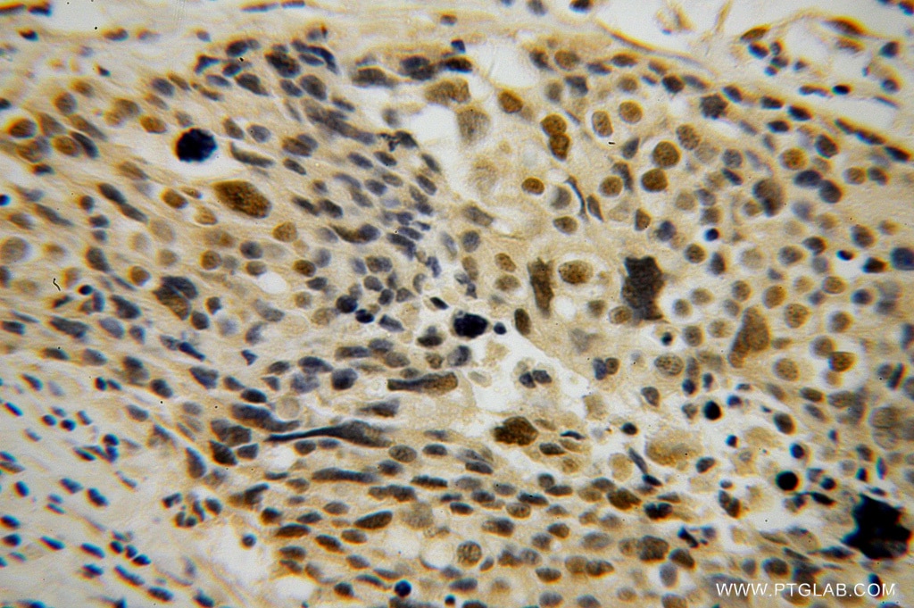 Immunohistochemistry (IHC) staining of human ovary tumor tissue using CARD8 Polyclonal antibody (14516-1-AP)