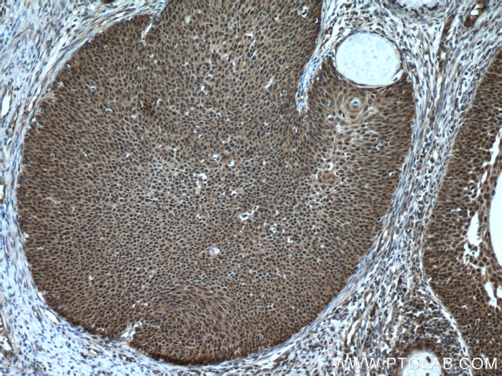 Immunohistochemistry (IHC) staining of human cervical cancer tissue using CARM1 Polyclonal antibody (55246-1-AP)