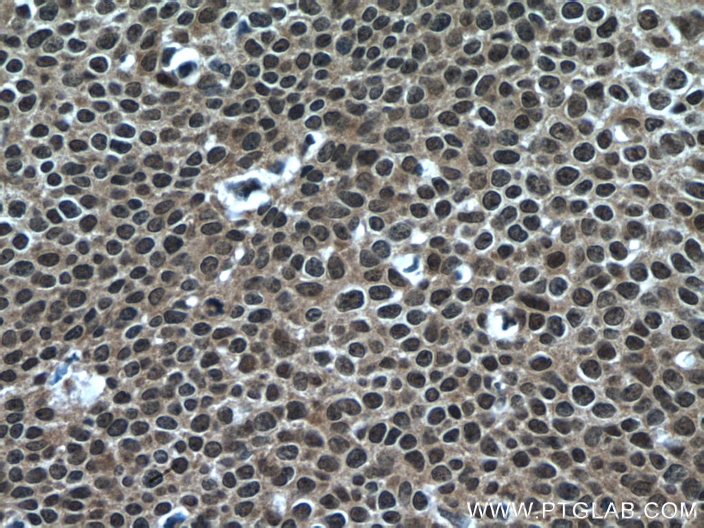 IHC staining of human cervical cancer using 55246-1-AP