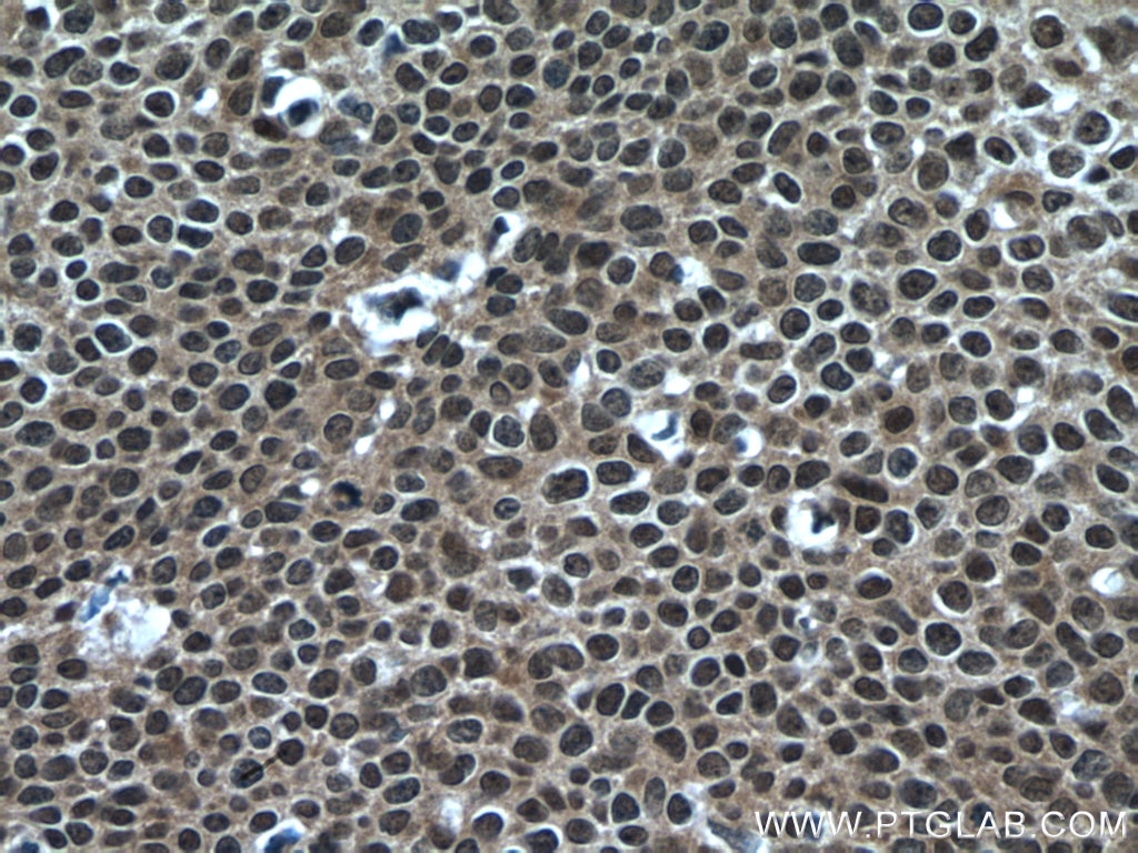 Immunohistochemistry (IHC) staining of human cervical cancer tissue using CARM1 Polyclonal antibody (55246-1-AP)