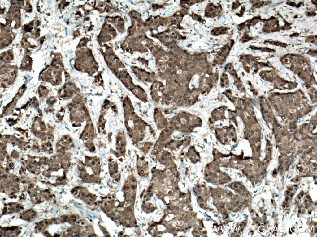 Immunohistochemistry (IHC) staining of human breast cancer tissue using CARM1 Polyclonal antibody (55246-1-AP)