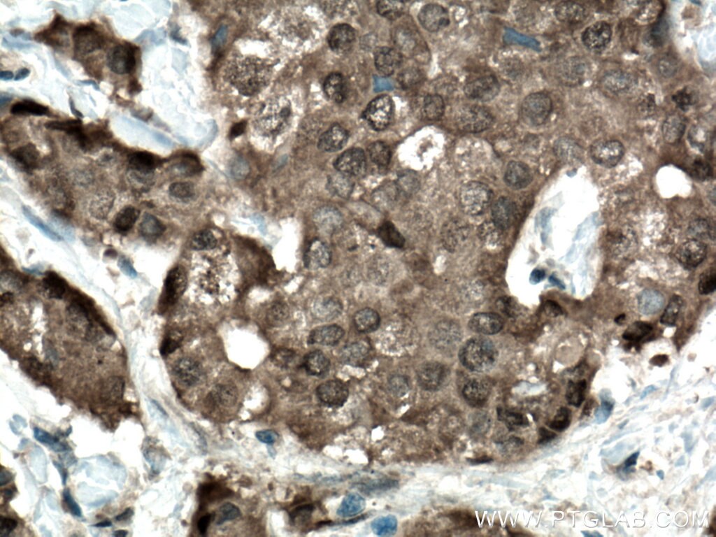 Immunohistochemistry (IHC) staining of human breast cancer tissue using CARM1 Polyclonal antibody (55246-1-AP)