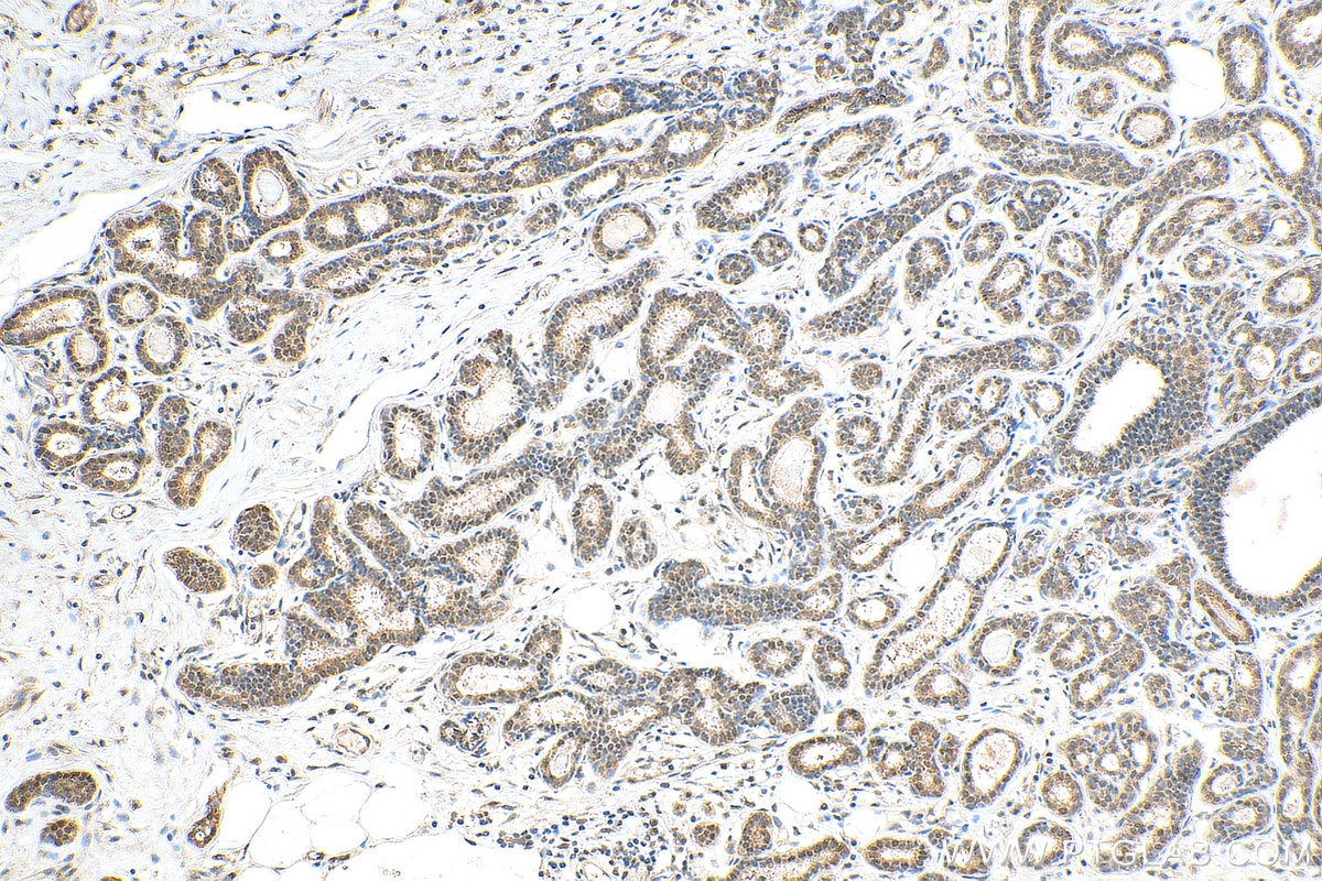 Immunohistochemistry (IHC) staining of human breast cancer tissue using CARM1 Polyclonal antibody (55246-1-AP)