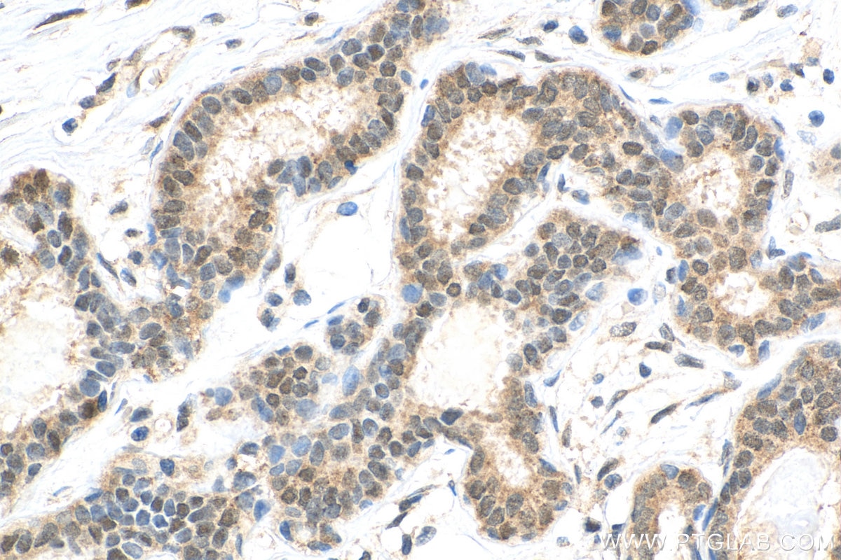 IHC staining of human breast cancer using 55246-1-AP