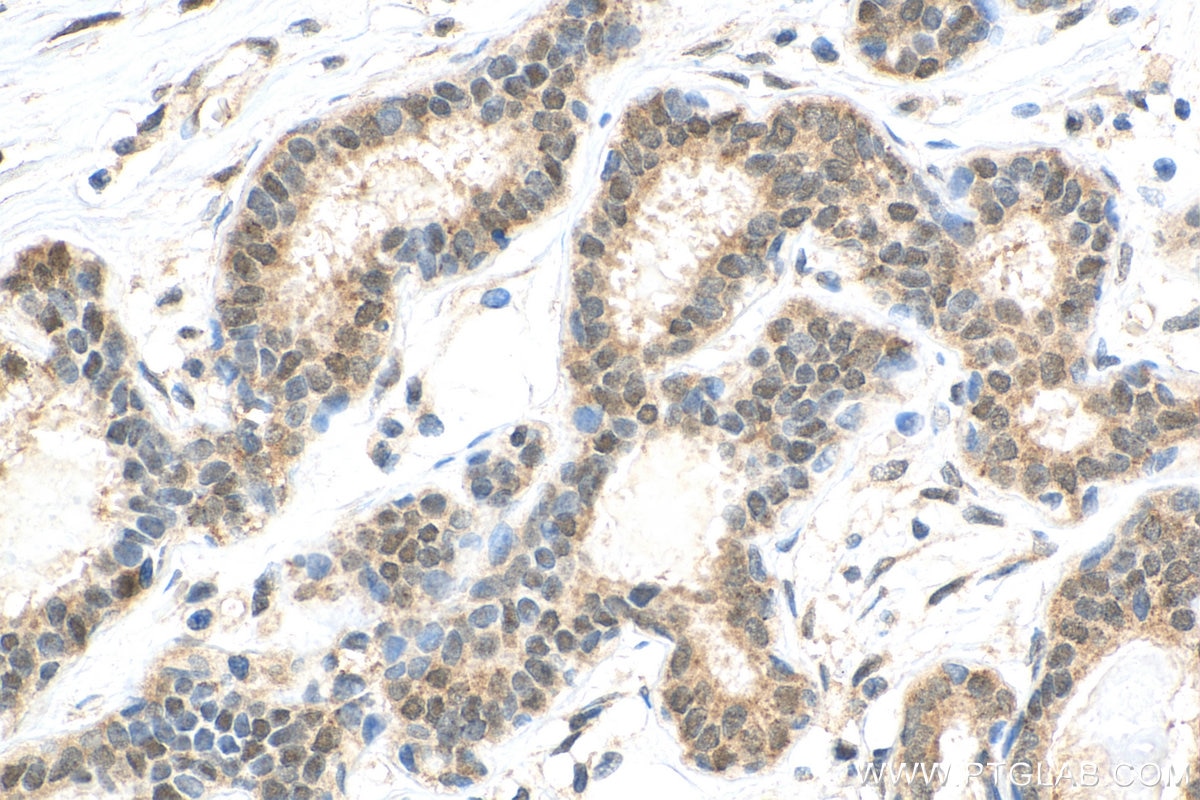 Immunohistochemistry (IHC) staining of human breast cancer tissue using CARM1 Polyclonal antibody (55246-1-AP)