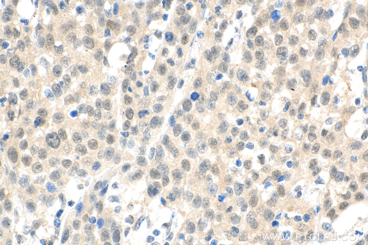 Immunohistochemistry (IHC) staining of human cervical cancer tissue using CARM1 Polyclonal antibody (55246-1-AP)