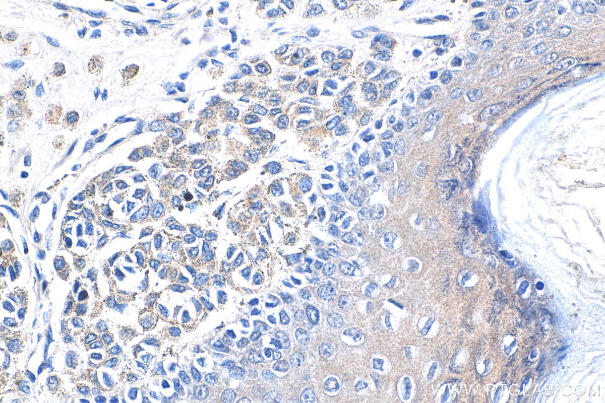 Immunohistochemistry (IHC) staining of human malignant melanoma tissue using CARM1 Polyclonal antibody (55246-1-AP)