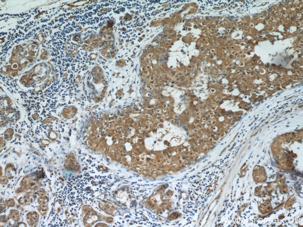 Immunohistochemistry (IHC) staining of human breast cancer tissue using CARM1 Polyclonal antibody (55246-1-AP)