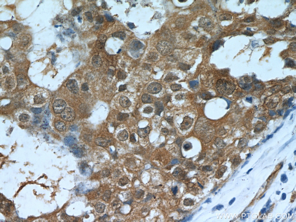 Immunohistochemistry (IHC) staining of human breast cancer tissue using CARM1 Polyclonal antibody (55246-1-AP)