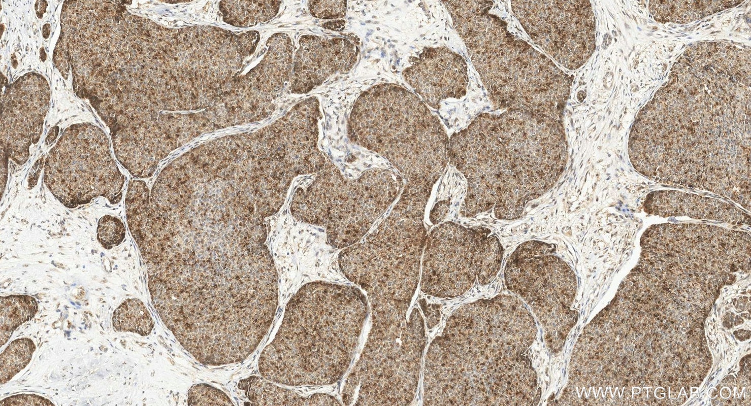 IHC staining of human breast cancer using 85146-3-RR (same clone as 85146-3-PBS) Immunohistochemistry (IHC) staining of human breast cancer tissue using CARM1 Recombinant monoclonal antibody (85146-3-RR)
