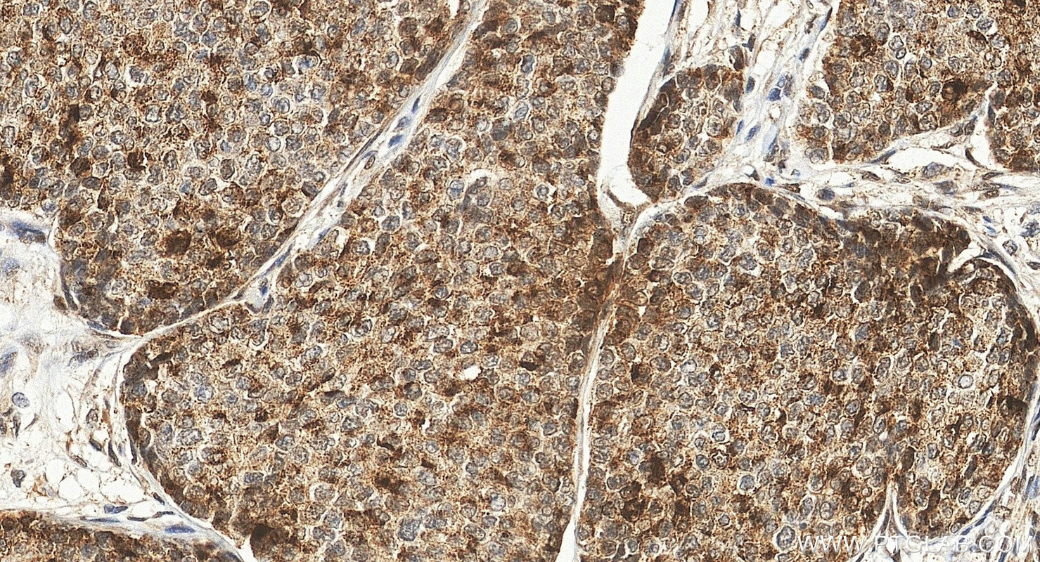 IHC staining of human breast cancer using 85146-3-RR (same clone as 85146-3-PBS) Immunohistochemistry (IHC) staining of human breast cancer tissue using CARM1 Recombinant monoclonal antibody (85146-3-RR)