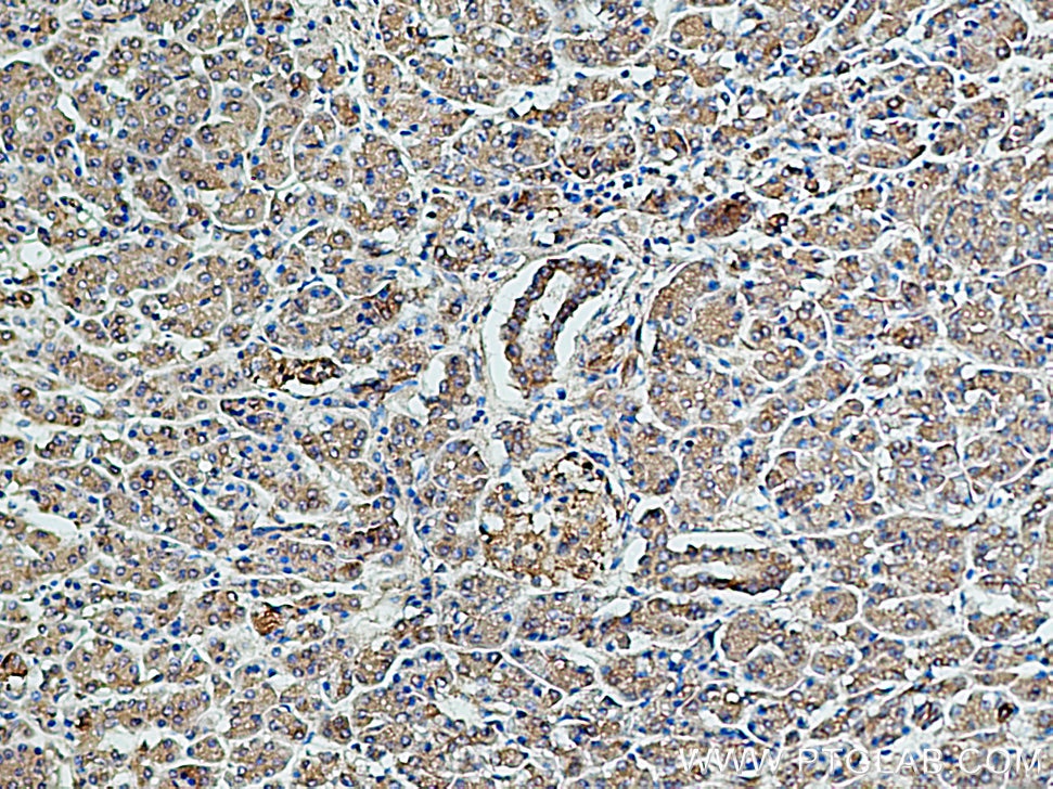 Immunohistochemistry (IHC) staining of human pancreas cancer tissue using CARS Polyclonal antibody (15296-1-AP)