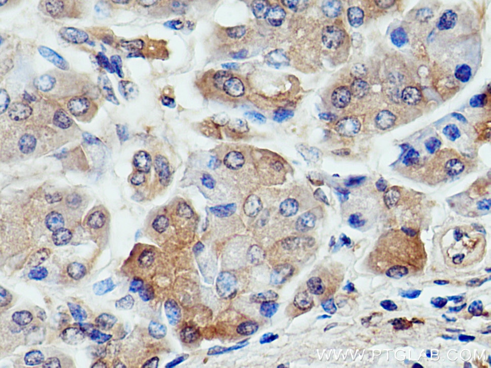 Immunohistochemistry (IHC) staining of human pancreas cancer tissue using CARS Polyclonal antibody (15296-1-AP)