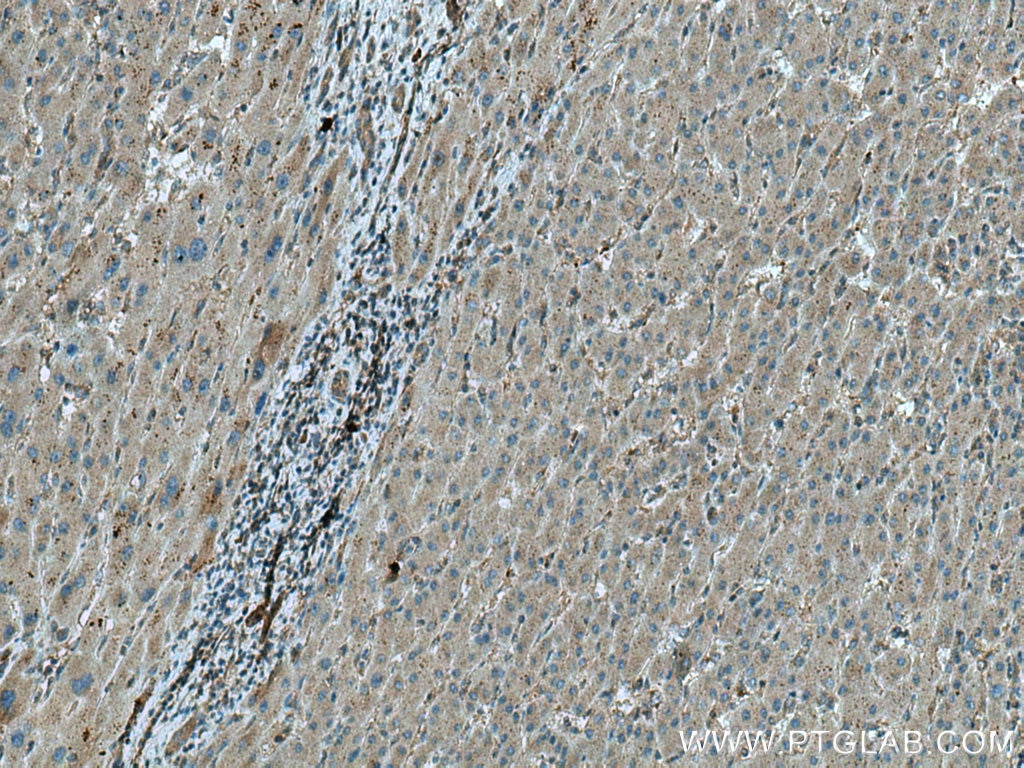 Immunohistochemistry (IHC) staining of human liver cancer tissue using MLN51/CASC3 Polyclonal antibody (18047-1-AP)