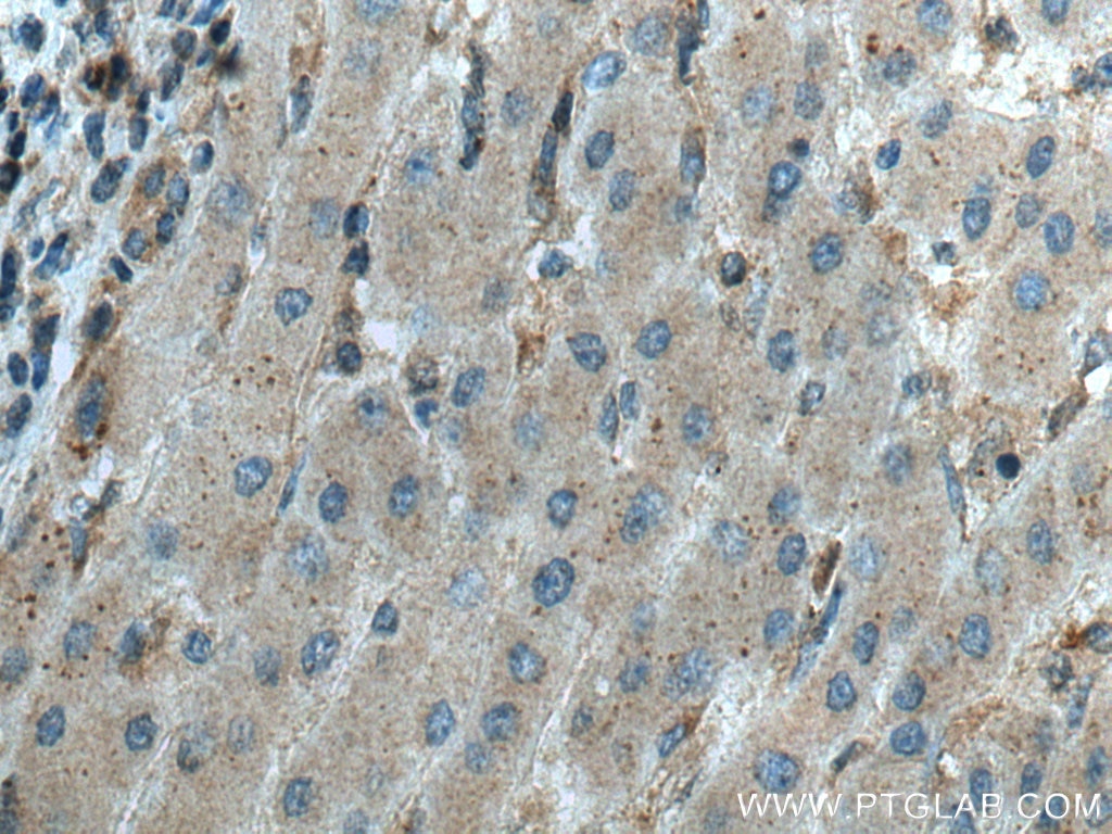 Immunohistochemistry (IHC) staining of human liver cancer tissue using MLN51/CASC3 Polyclonal antibody (18047-1-AP)