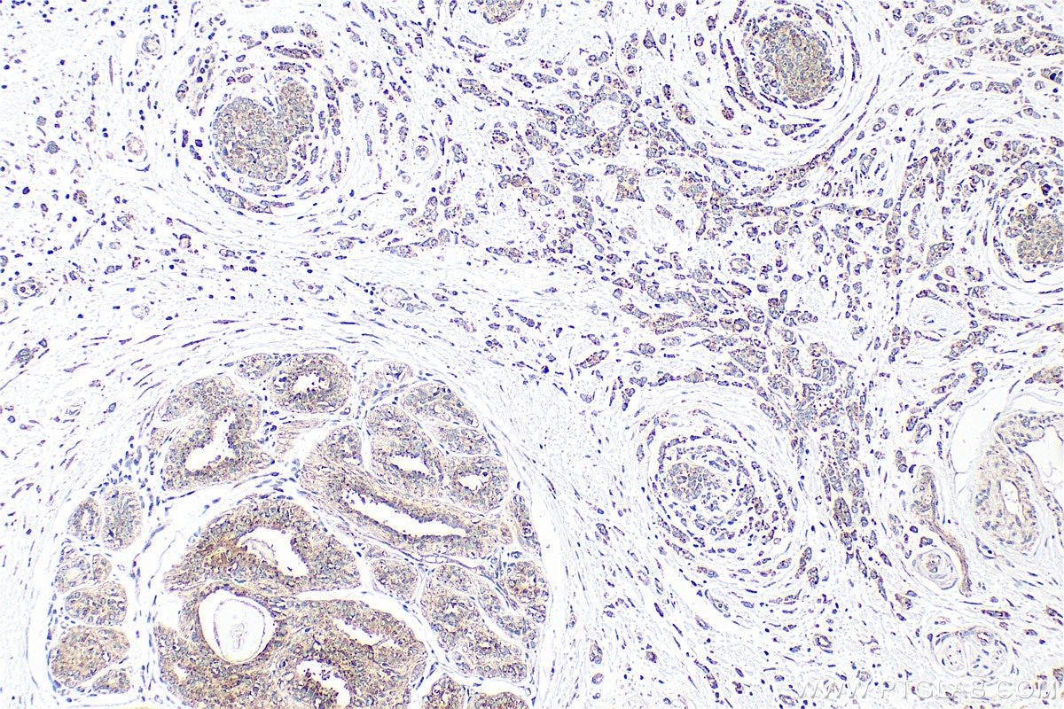 Immunohistochemistry (IHC) staining of human breast cancer tissue using CASD1 Polyclonal antibody (34104-1-AP)