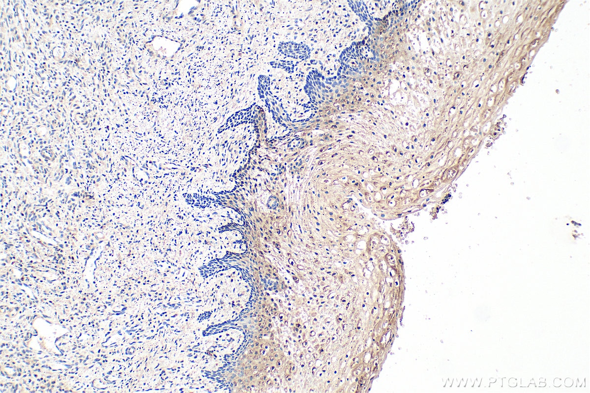 Immunohistochemistry (IHC) staining of human cervical cancer tissue using CASD1 Polyclonal antibody (34104-1-AP)