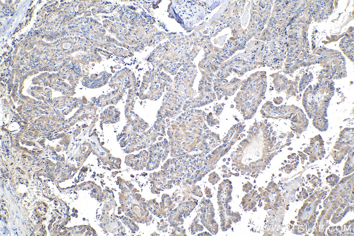 Immunohistochemistry (IHC) staining of human thyroid cancer tissue using CASK Polyclonal antibody (55277-1-AP)