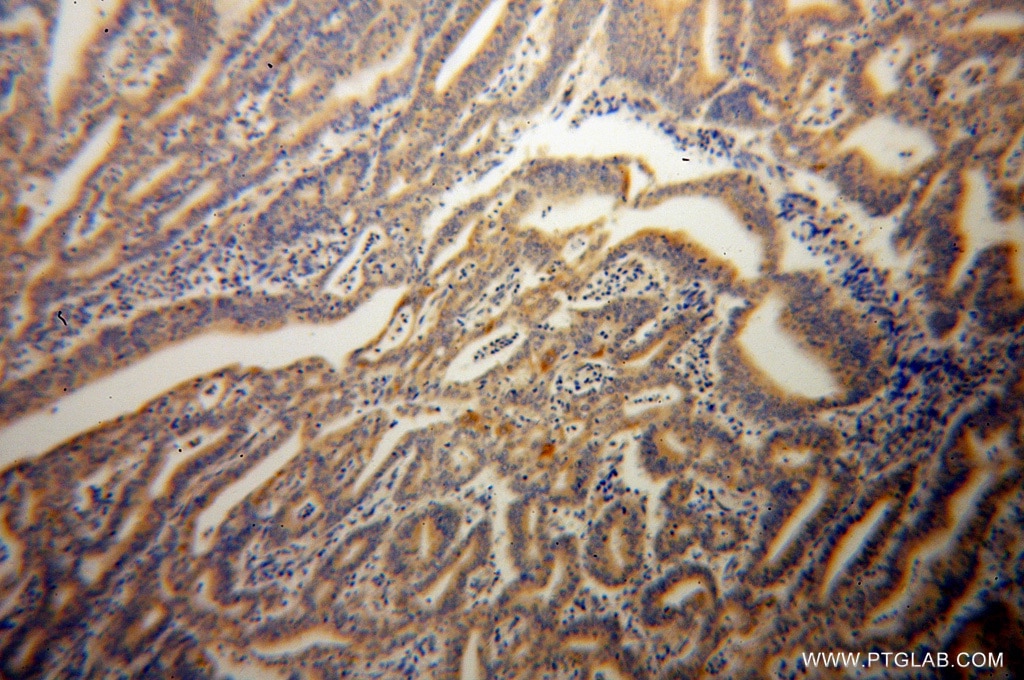 Immunohistochemistry (IHC) staining of human endometrial cancer tissue using Caspase 10/p23/17/p12 Polyclonal antibody (14311-1-AP)