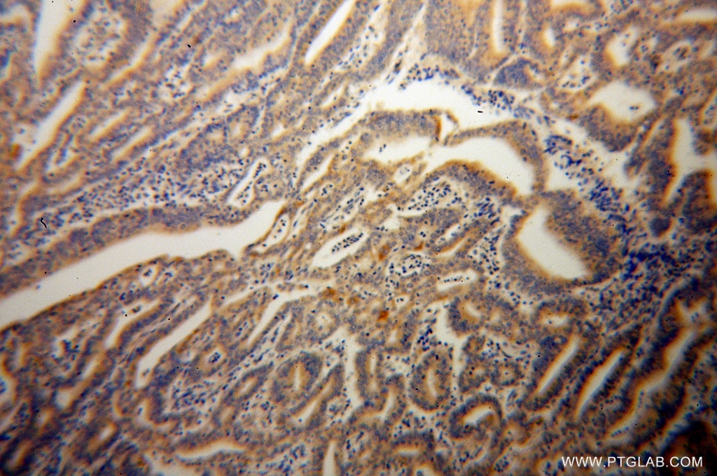 Immunohistochemistry (IHC) staining of human endometrial cancer tissue using Caspase 10 Polyclonal antibody (14311-1-AP)
