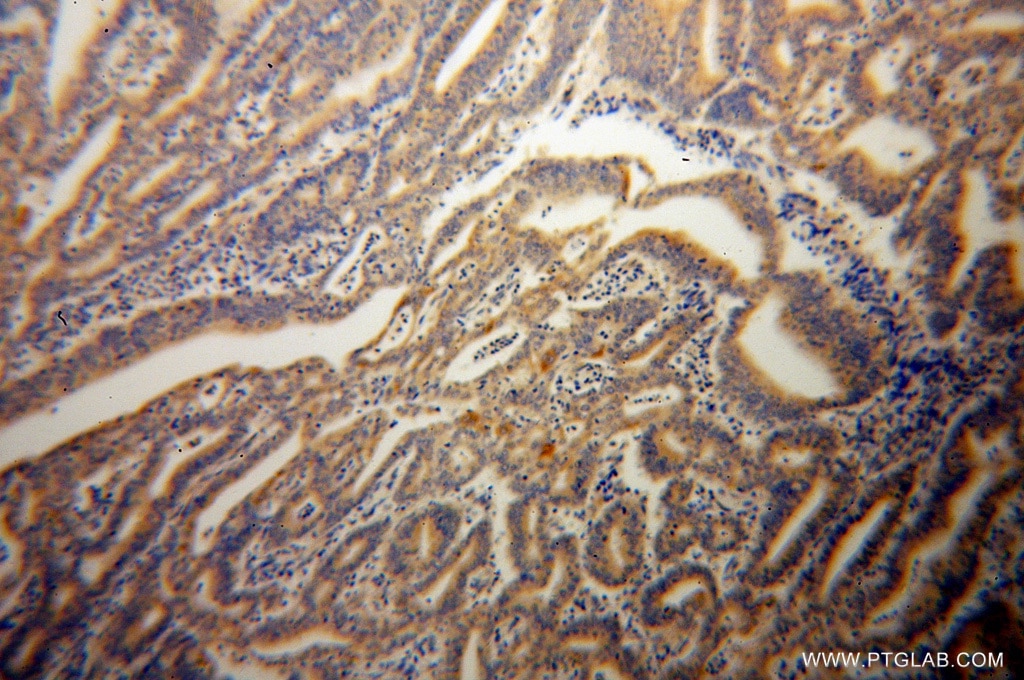 IHC staining of human endometrial cancer using 14311-1-AP