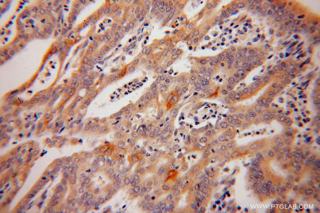 Immunohistochemistry (IHC) staining of human endometrial cancer tissue using Caspase 10/p23/17/p12 Polyclonal antibody (14311-1-AP)