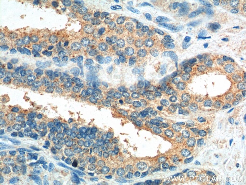 Immunohistochemistry (IHC) staining of human prostate hyperplasia tissue using Caspase 12 Polyclonal antibody (55238-1-AP)
