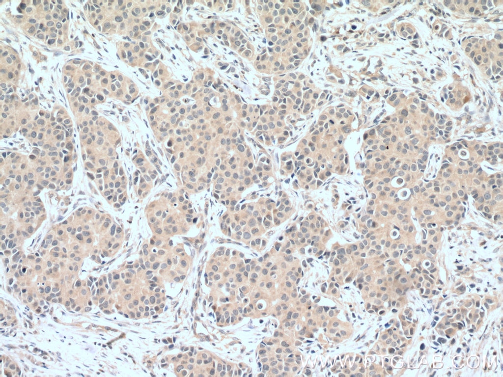 Immunohistochemistry (IHC) staining of human breast cancer tissue using Caspase 3(human specific) Monoclonal antibody (66470-1-Ig)