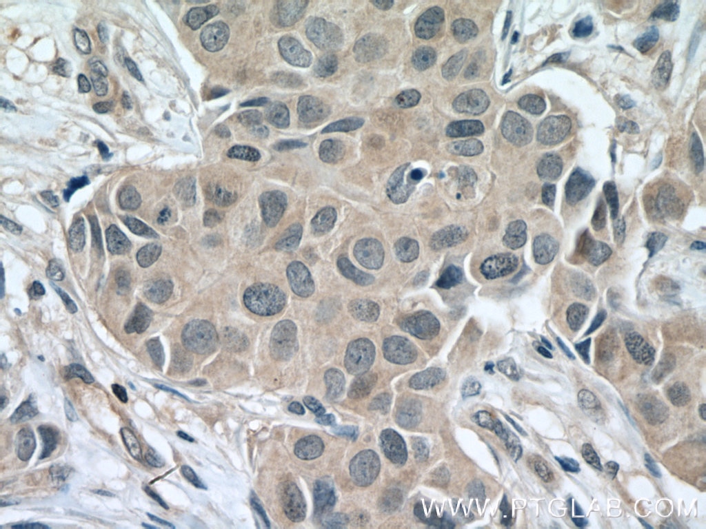 Immunohistochemistry (IHC) staining of human breast cancer tissue using Caspase 3(human specific) Monoclonal antibody (66470-1-Ig)