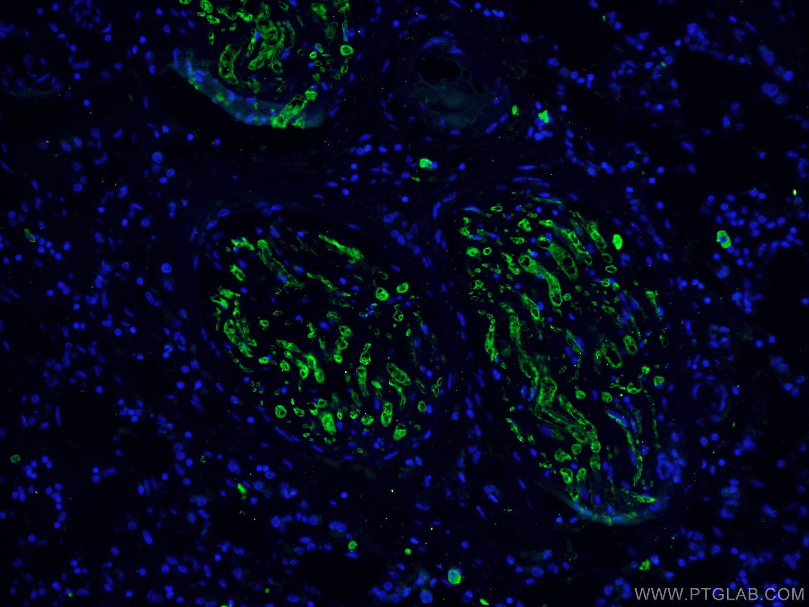 Immunofluorescence (IF) / fluorescent staining of human breast cancer tissue using Caspase 3/p17/p19 Monoclonal antibody (66470-2-Ig)