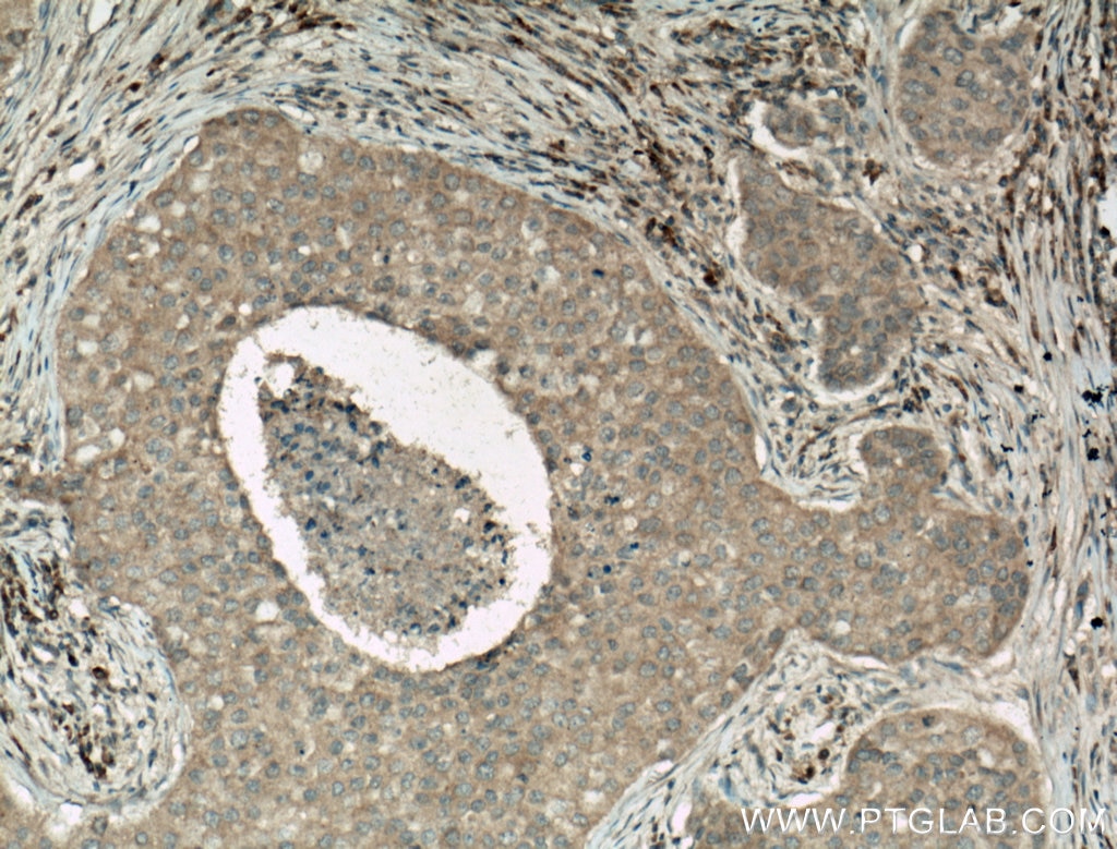 Immunohistochemistry (IHC) staining of human breast cancer tissue using Caspase 3/p17/p19 Monoclonal antibody (66470-2-Ig)