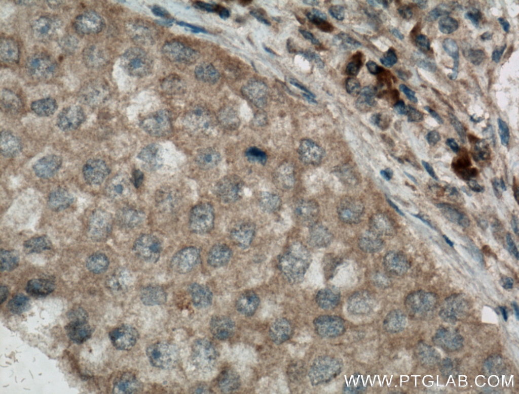 IHC staining of human breast cancer using 66470-2-Ig