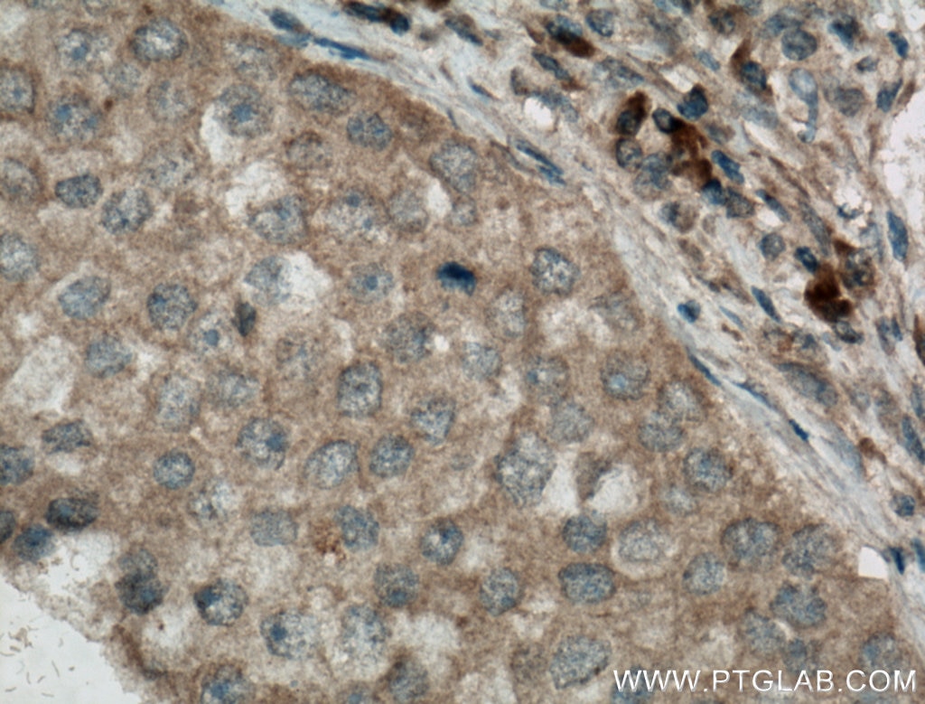 Immunohistochemistry (IHC) staining of human breast cancer tissue using Caspase 3/p17/p19 Monoclonal antibody (66470-2-Ig)