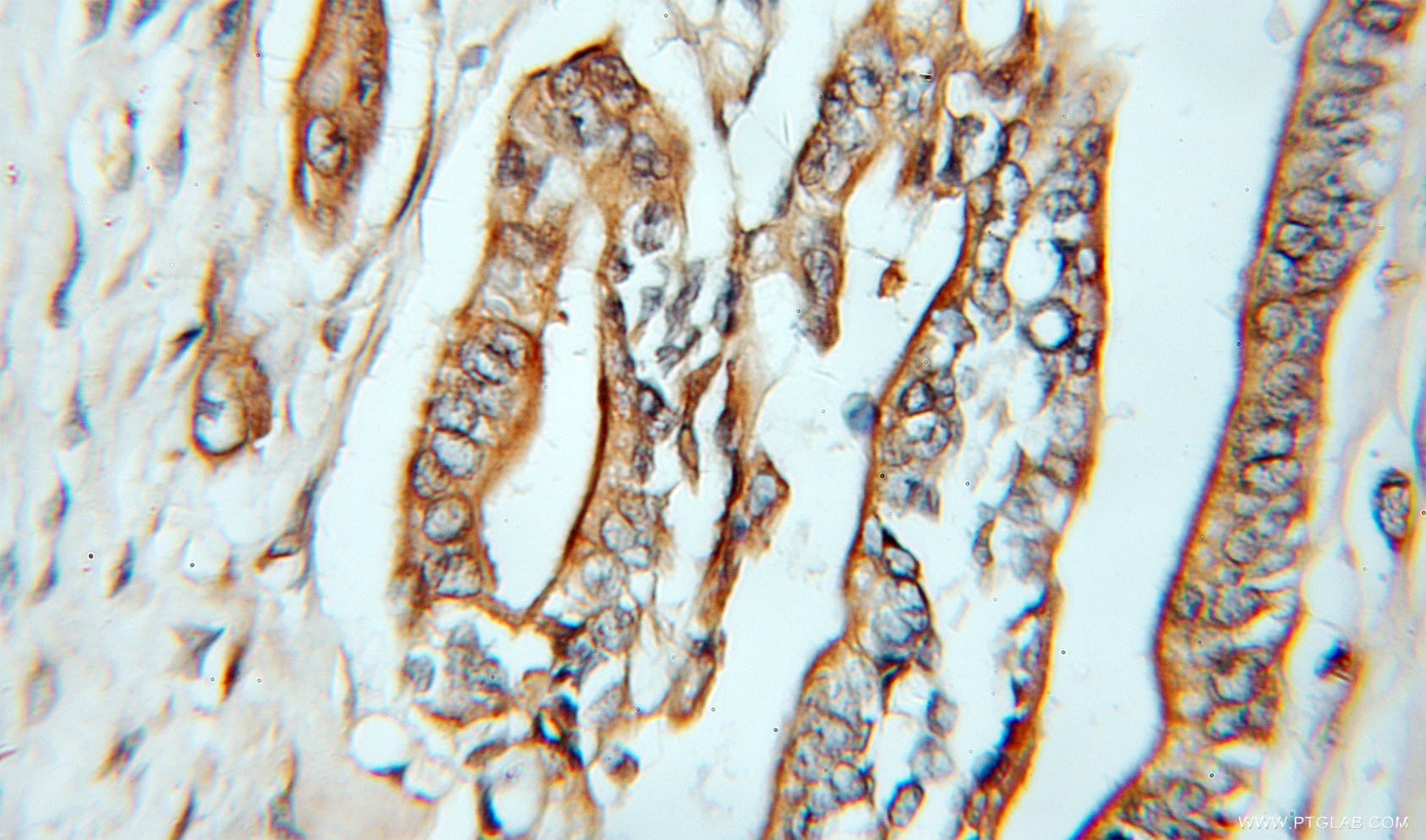 Immunohistochemistry (IHC) staining of human pancreas cancer tissue using Caspase 4/p20/p10 Polyclonal antibody (11856-1-AP)