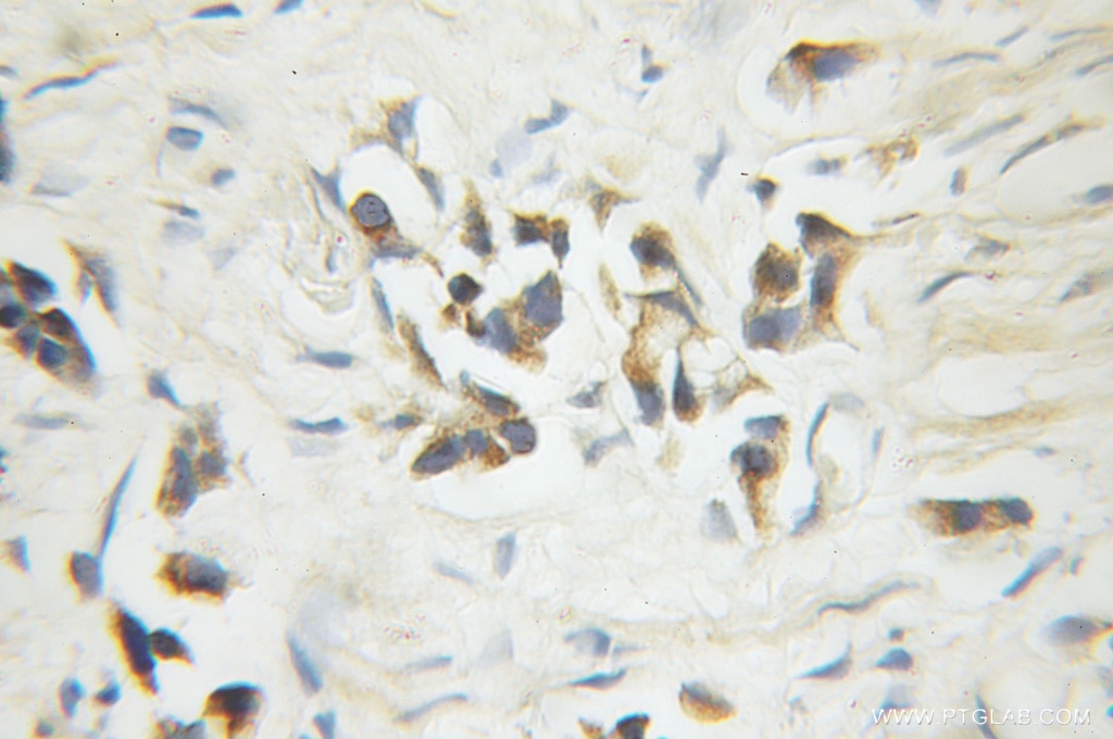 Immunohistochemistry (IHC) staining of human prostate cancer tissue using Caspase 6/p18/p11 Polyclonal antibody (10198-1-AP)