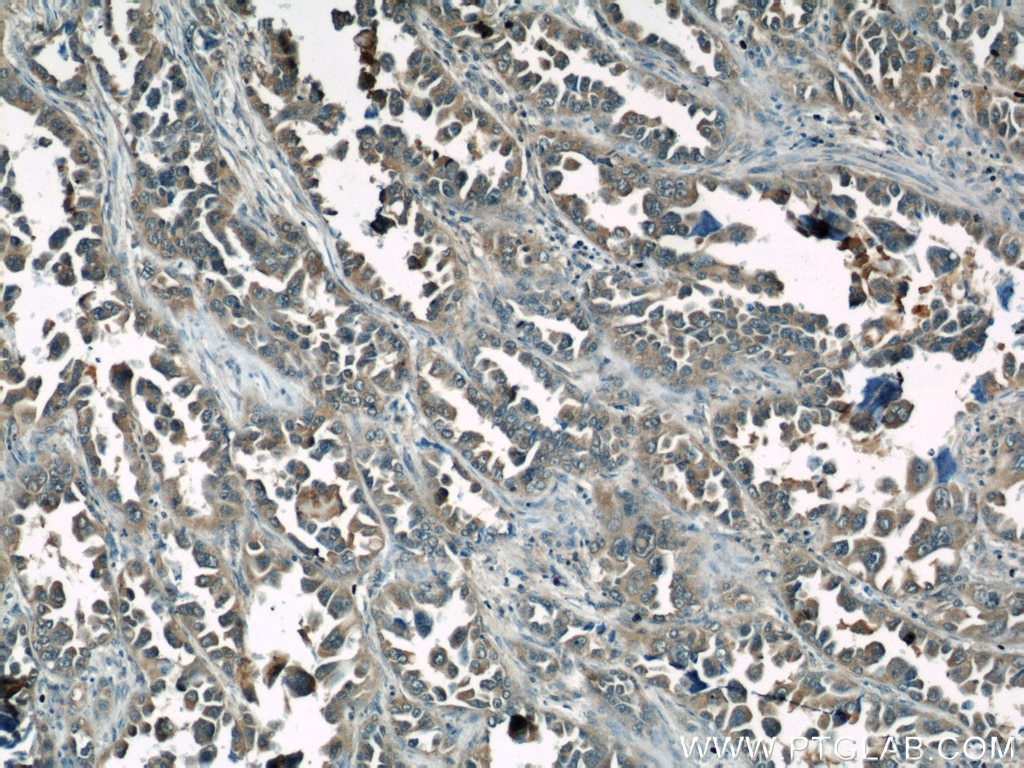 Immunohistochemistry (IHC) staining of human lung cancer tissue using Caspase 6/p18/p11 Polyclonal antibody (10198-1-AP)