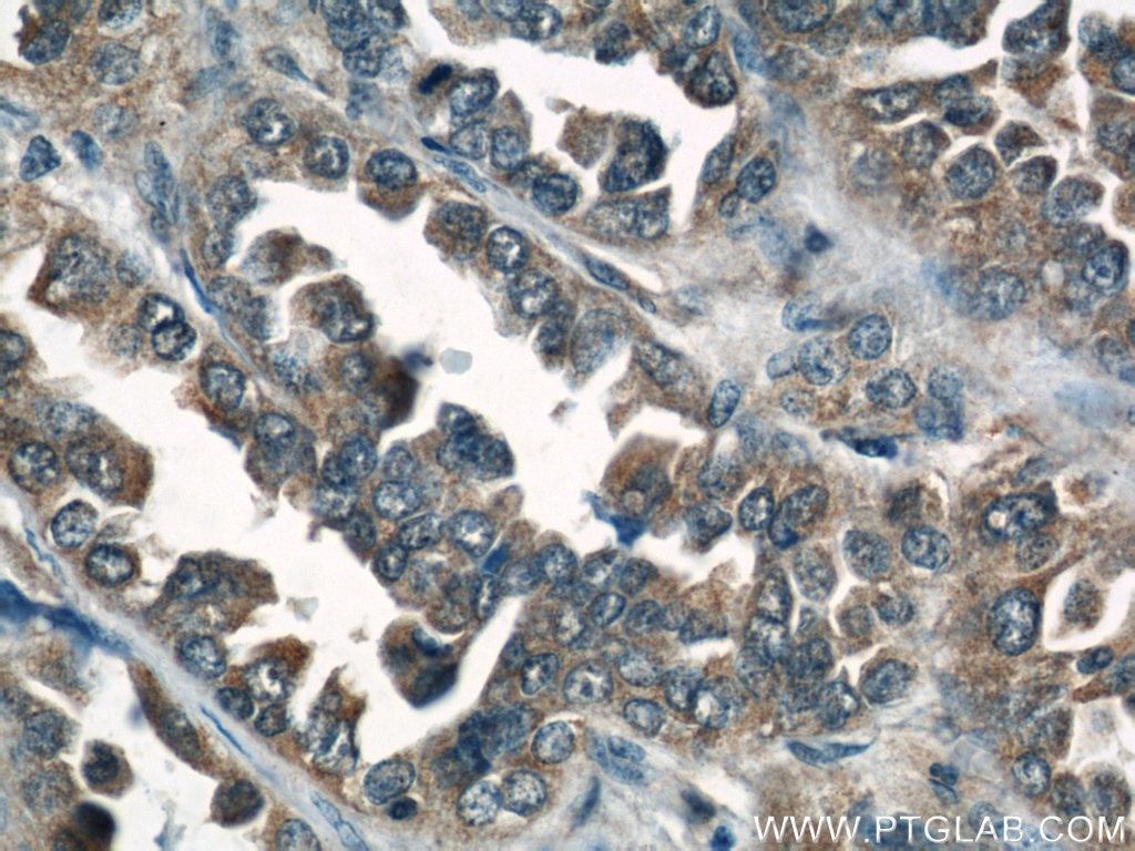 IHC staining of human lung cancer using 10198-1-AP