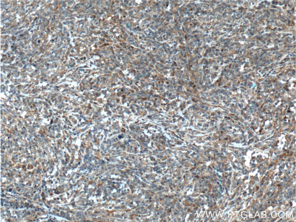 Immunohistochemistry (IHC) staining of human lymphoma tissue using Caspase 8/p43/p18 Polyclonal antibody (13423-1-AP)