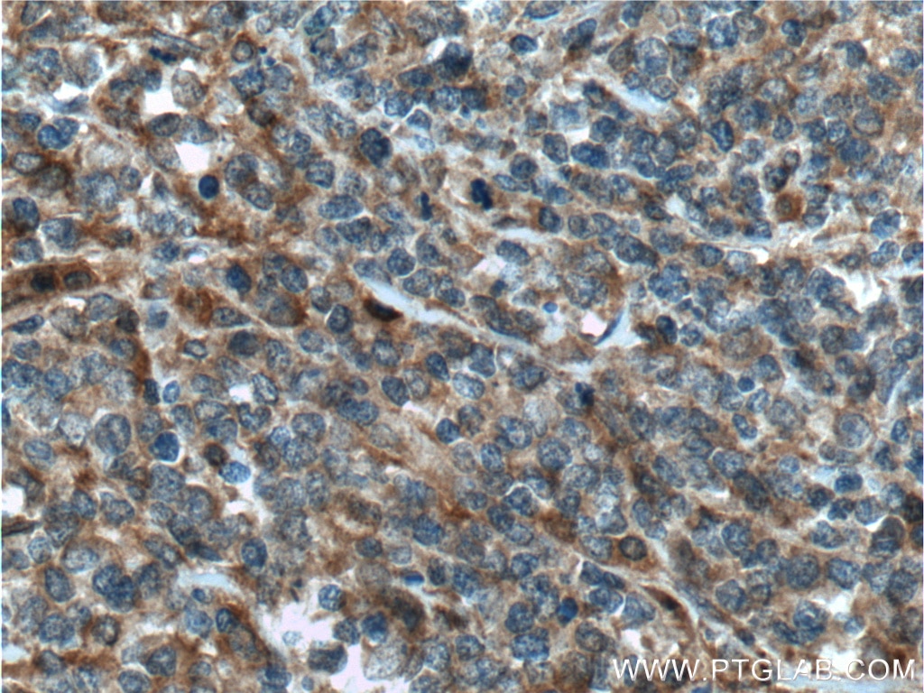 Immunohistochemistry (IHC) staining of human lymphoma tissue using Caspase 8/p43/p18 Polyclonal antibody (13423-1-AP)