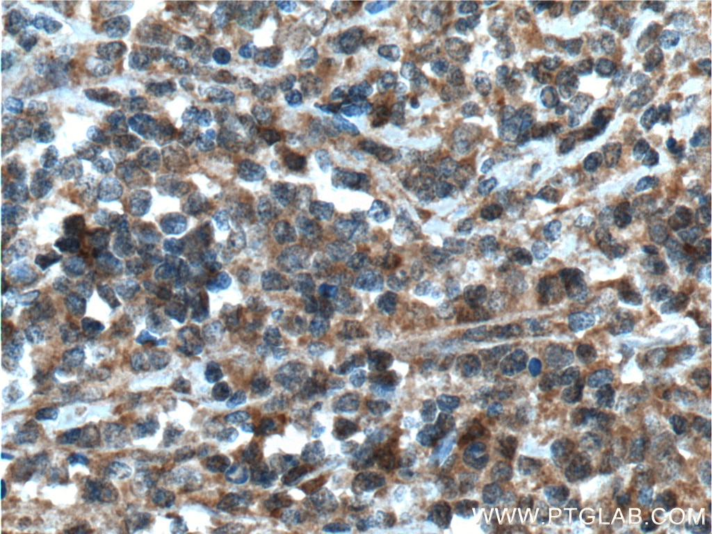 Immunohistochemistry (IHC) staining of human lymphoma tissue using Caspase 8/p43/p18 Polyclonal antibody (13423-1-AP)