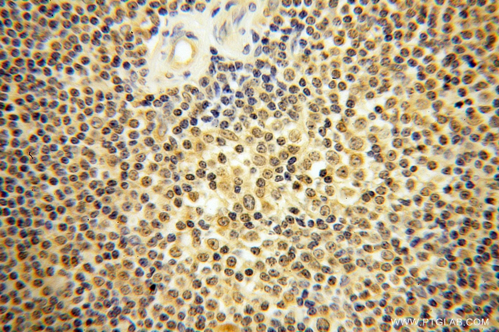 Immunohistochemistry (IHC) staining of human lymphoma tissue using Caspase 8/p43/p18 Polyclonal antibody (13423-1-AP)