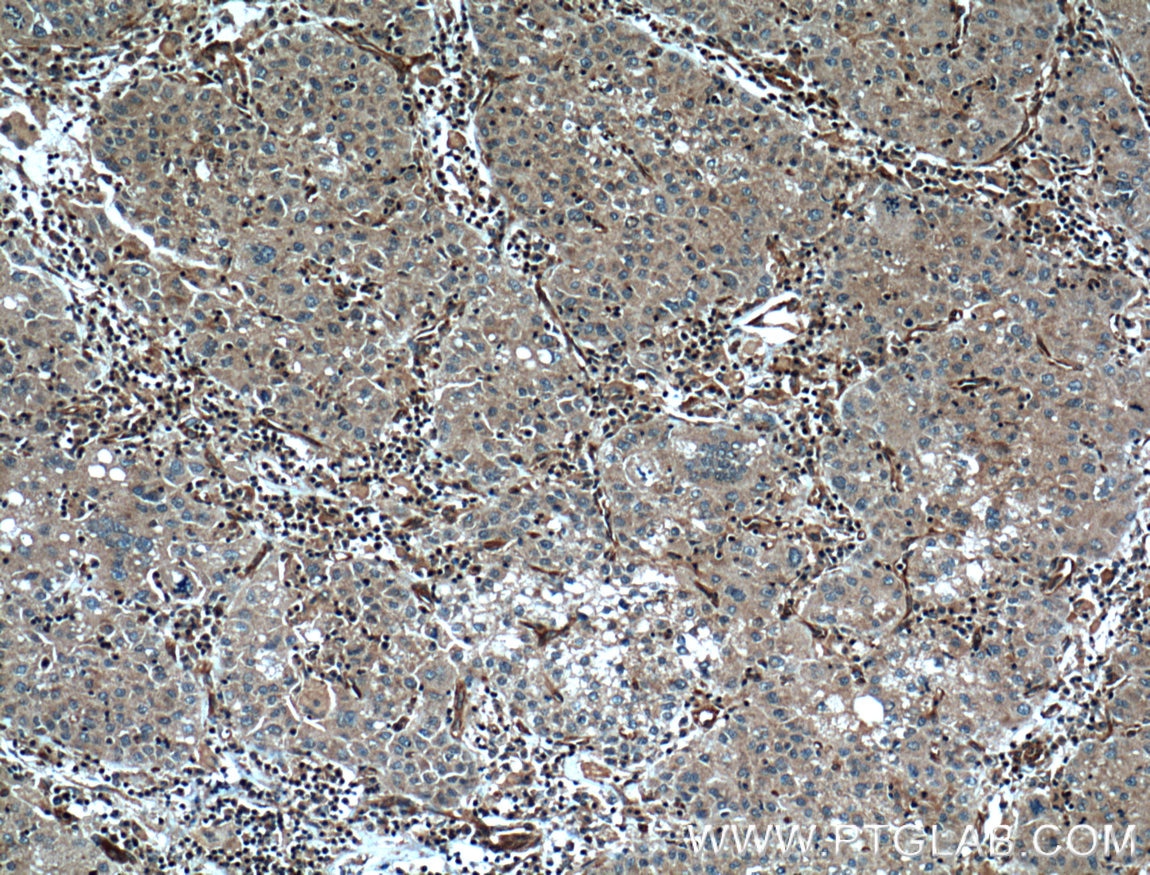 Immunohistochemistry (IHC) staining of human liver cancer tissue using Caspase 8/p43/p18 Monoclonal antibody (66093-1-Ig)