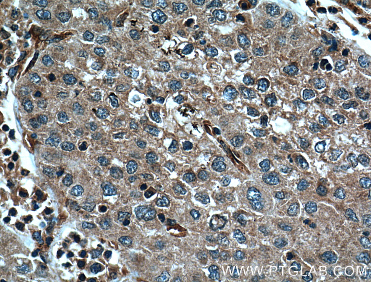 Immunohistochemistry (IHC) staining of human liver cancer tissue using Caspase 8/p43/p18 Monoclonal antibody (66093-1-Ig)