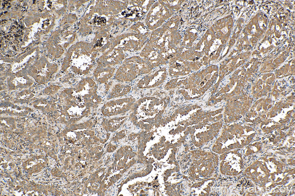 Immunohistochemistry (IHC) staining of human lung cancer tissue using Calpastatin Polyclonal antibody (12250-1-AP)