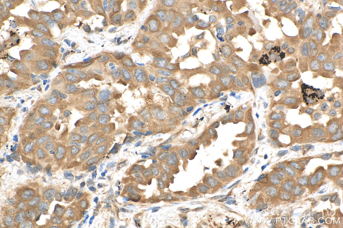 Immunohistochemistry (IHC) staining of human lung cancer tissue using Calpastatin Polyclonal antibody (12250-1-AP)